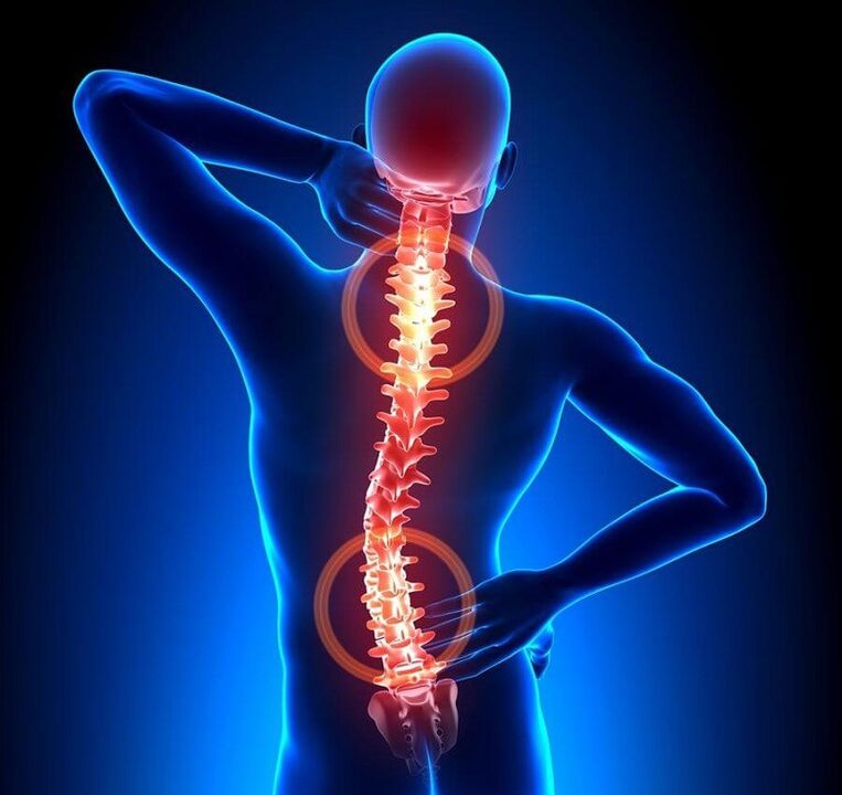 остеохондроза на 'рбетот како причина за болки во грбот