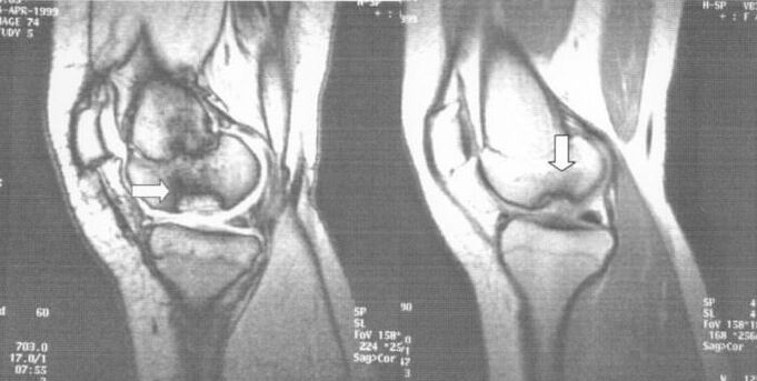 рентген на остеохондроза дисеканс во коленото зглоб