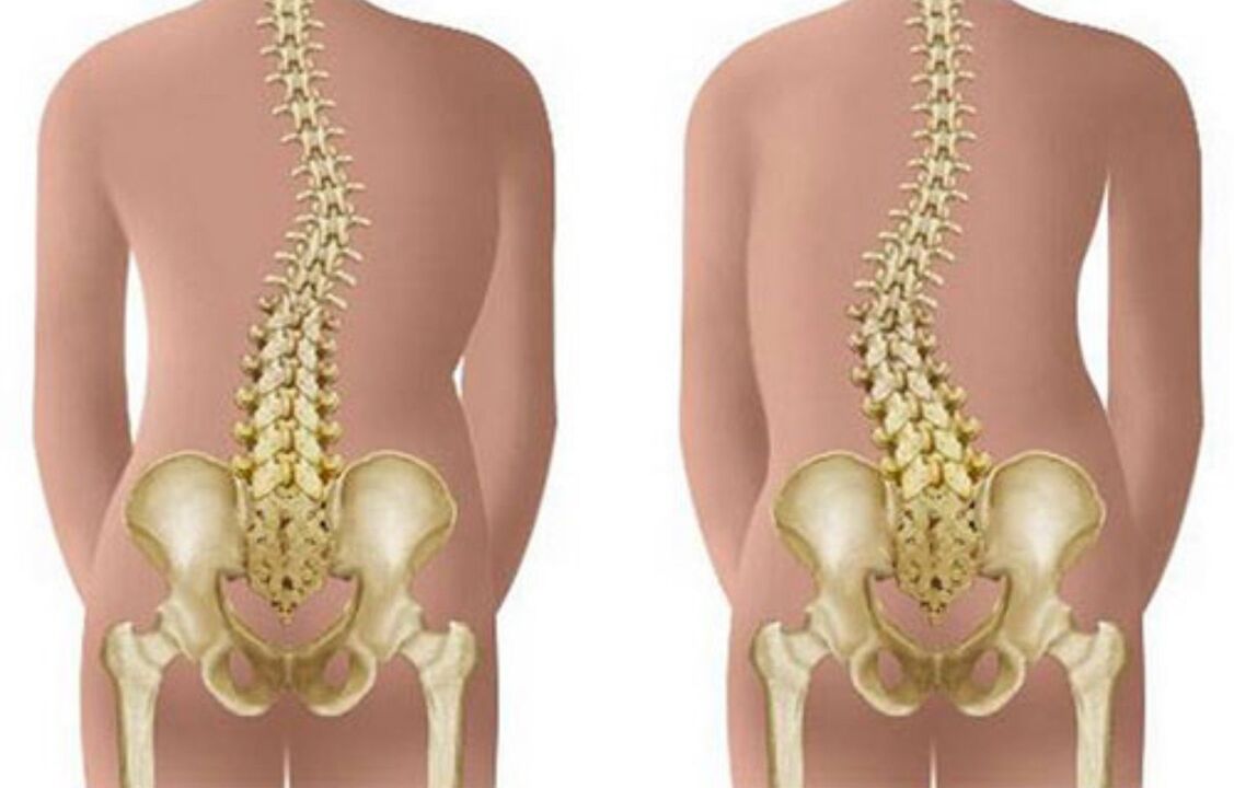сколиозата како причина за болки во грбот во пределот на лопатките